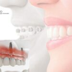 Ortodoncia precio Pozuelo: cuidamos tu sonrisa y tu presupuesto