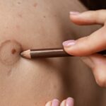 Vitiligo Camouflage Treatment in Dubai — Natural, Lasting Results