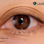 Pterygium Surgery Recovery | Pterygiumhouston.com