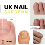 Fungal Nails Removal: Safe Care & Quick Recovery in the UK
