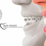 Ortodoncia Invisible en Pozuelo de Alarcón | Clínica Vilar Sancho