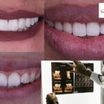 إصلاح كسر الأسنان الأمامية بثقة وجمال ابتسامتك