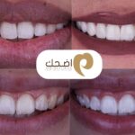 ابتسامة هوليوود: تقنيات الفينير وتبييض الأسنان للحصول على ابتسامة مثالية