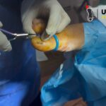 Ingrown Toenails Removal: Quick, Expert Care for Fast Relief