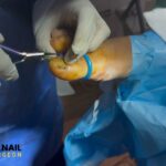 Nail Surgery: Same-Day Relief for Toenail Problems